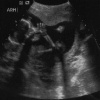 Ultrasound of Kirsten